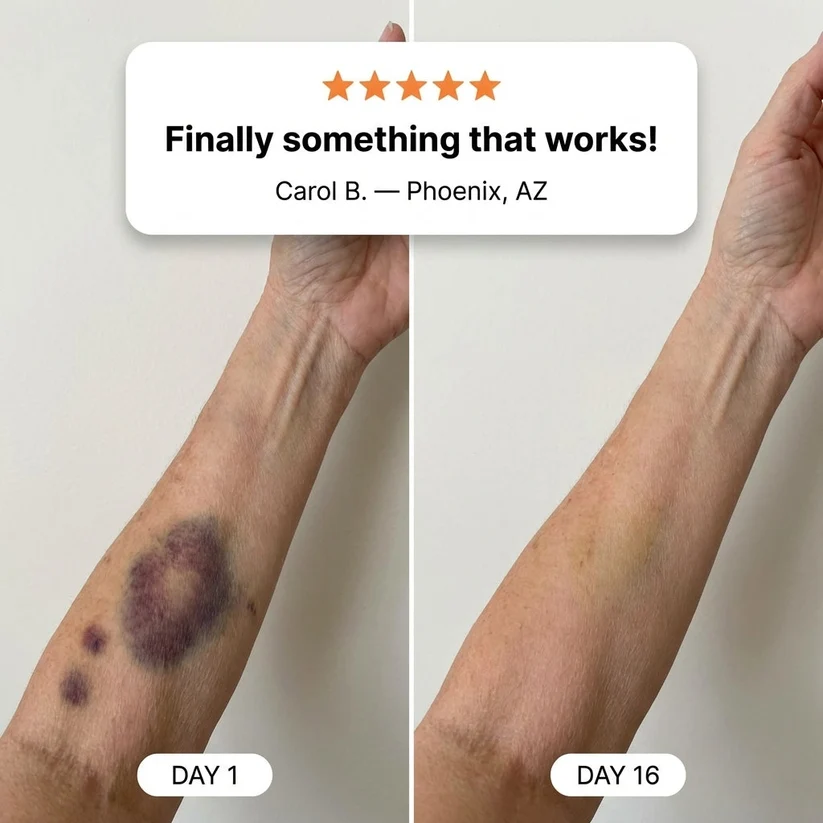 ✨👩‍⚕️VELNORS® Bruise Repair & Skin-Strengthening Cream-Advanced daily care for bruise-prone skin