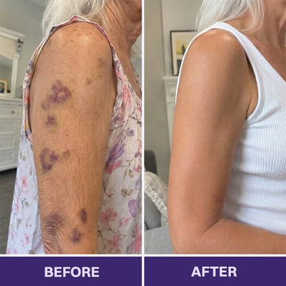 ✨👩‍⚕️VELNORS® Bruise Repair & Skin-Strengthening Cream-Advanced daily care for bruise-prone skin