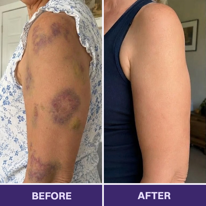 ✨👩‍⚕️VELNORS® Bruise Repair & Skin-Strengthening Cream-Advanced daily care for bruise-prone skin