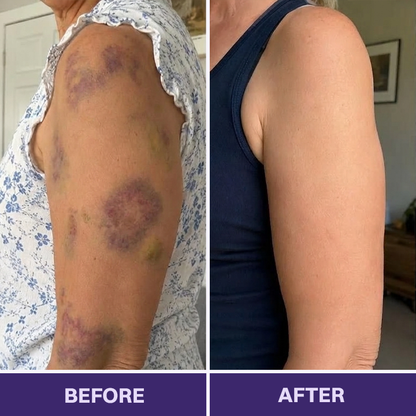 ✨👩‍⚕️VELNORS® Bruise Repair & Skin-Strengthening Cream-Advanced daily care for bruise-prone skin