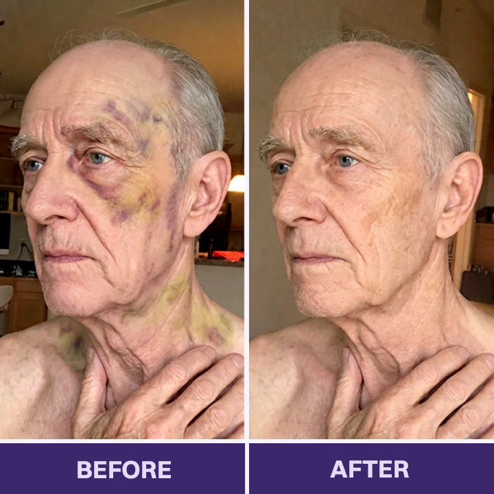 ✨👩‍⚕️VELNORS® Bruise Repair & Skin-Strengthening Cream-Advanced daily care for bruise-prone skin